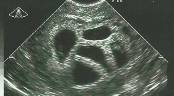 This mother refused the abortion of her quintuplets and 20 years later she shows THIS picture! Wow! quintuplets