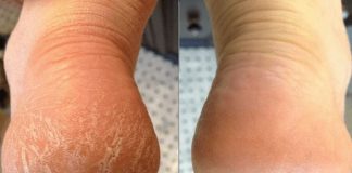 Αυτό το φτηνό προϊόν το οποίο ήδη έχετε στην κουζίνα σας μπορεί να σας βοηθήσει στις σκασμένες φτέρνες