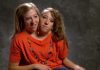 Years after these Siamese twins were born, they shared shocking news
