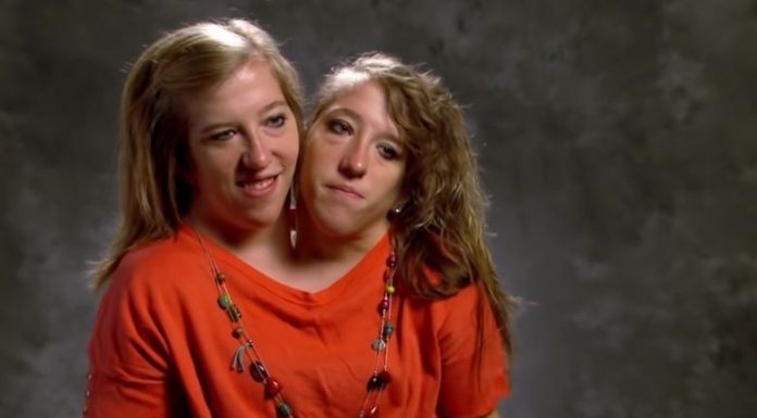 Years after these Siamese twins were born, they shared shocking news