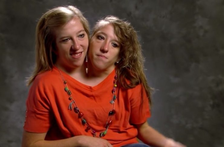 Years after these Siamese twins were born, they shared shocking news
