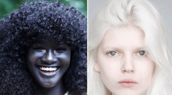 20 People With Unique Genetic Traits That Are Hard to Forget
