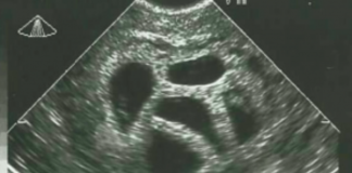 This mother refused the abortion of her quintuplets and 20 years later she shows THIS picture! Wow!