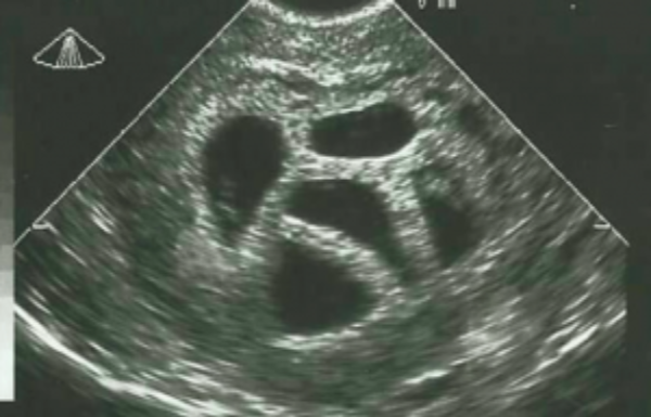 This mother refused the abortion of her quintuplets and 20 years later she shows THIS picture! Wow!