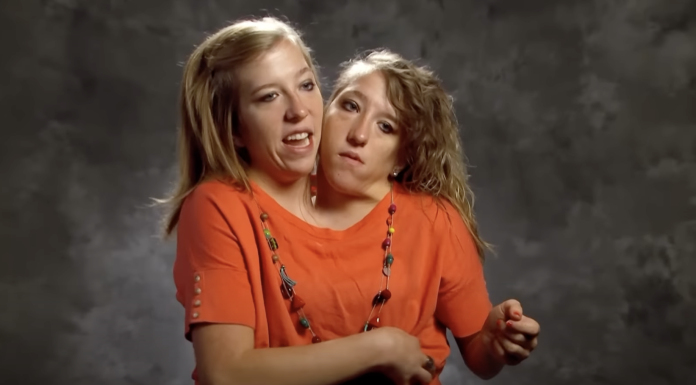 Years After These Siamese Twins Were Born, They Shared Shocking News